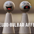 Pseudo-bulbar Affect: Emotional Incontinence