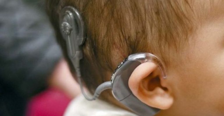 Cochlear Implant Program in Rural India